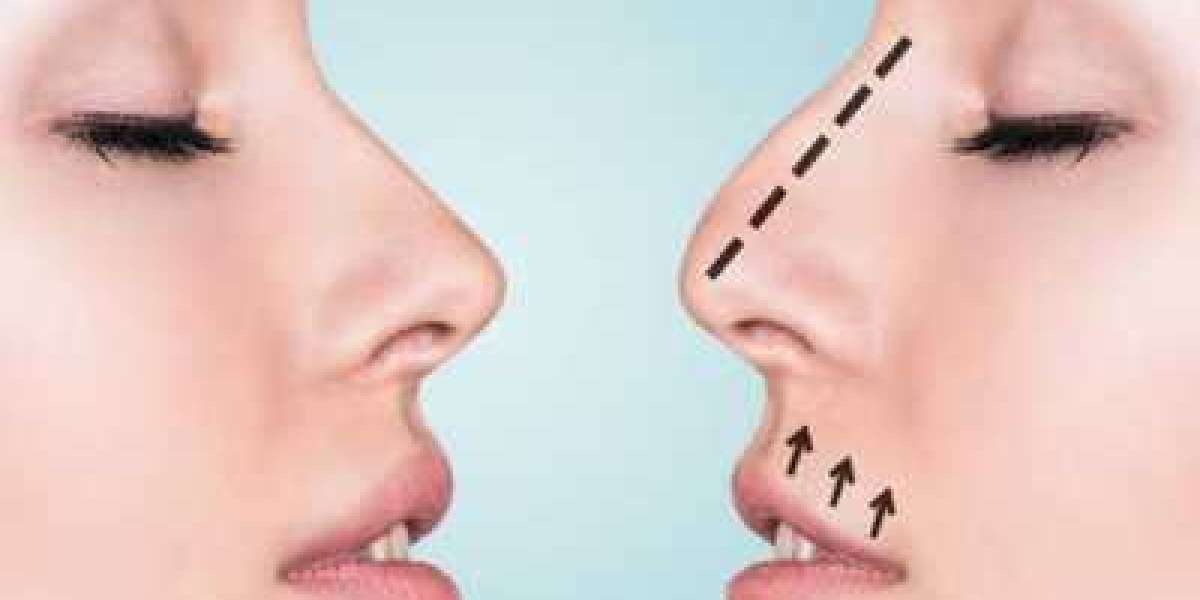 The Best Septorhinoplasty Surgery in Delhi for Function & Aesthetics