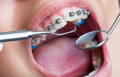 Life After Orthodontic Treatment: Retainers and Long-Term Maintenance