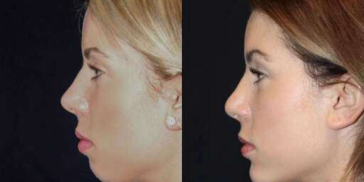 Chin Fillers at the Best Aesthetic Clinic in dubai