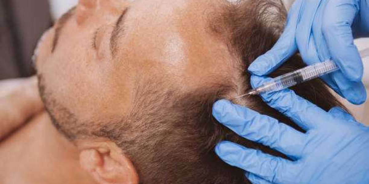 Looking for a Hair Loss Solution? Consider PRP in London