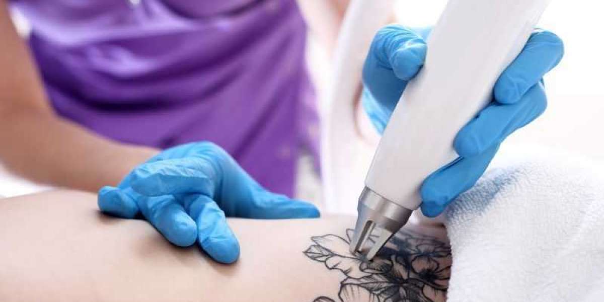 Can All Tattoos Be Removed? Insights from Dubai’s Tattoo Removal Experts