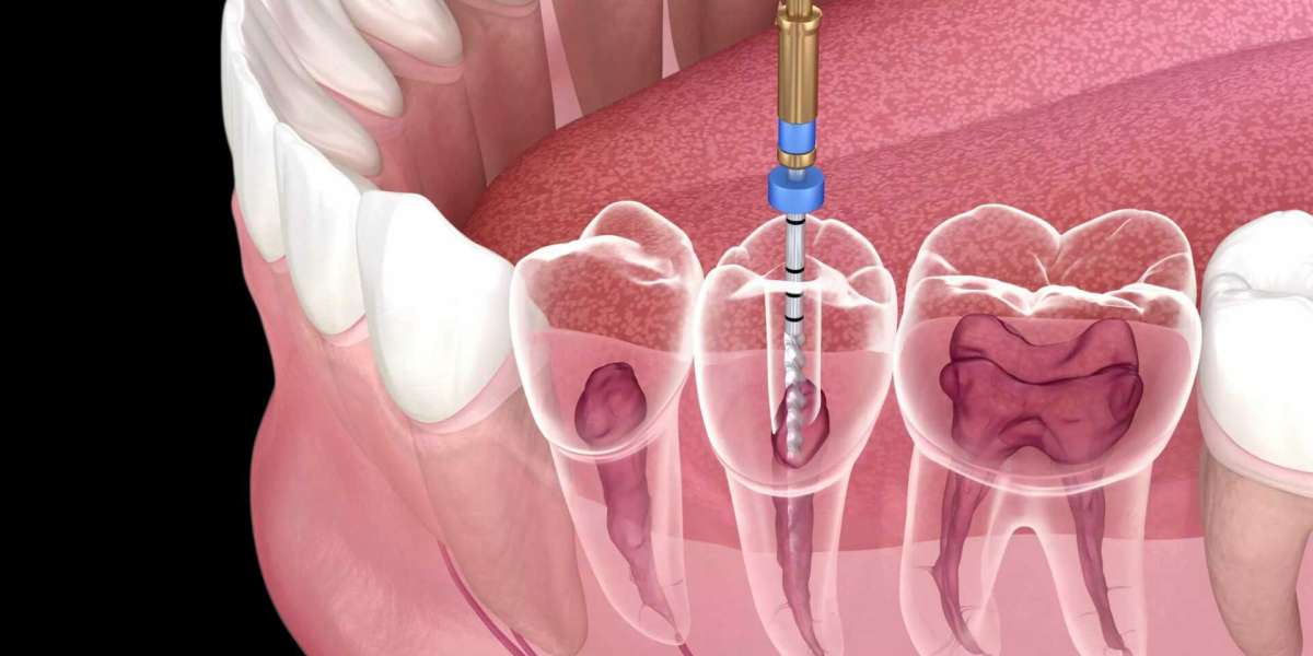 Is Root Canal Treatment Painful? Debunking Myths in Islamabad