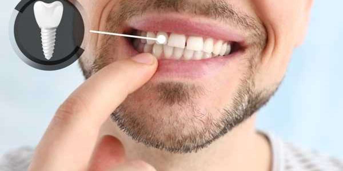 Benefits of Getting Dental Implants in Islamabad