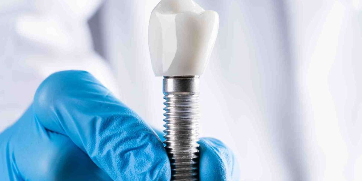 The Truth About Dental Implants: What You Should Know