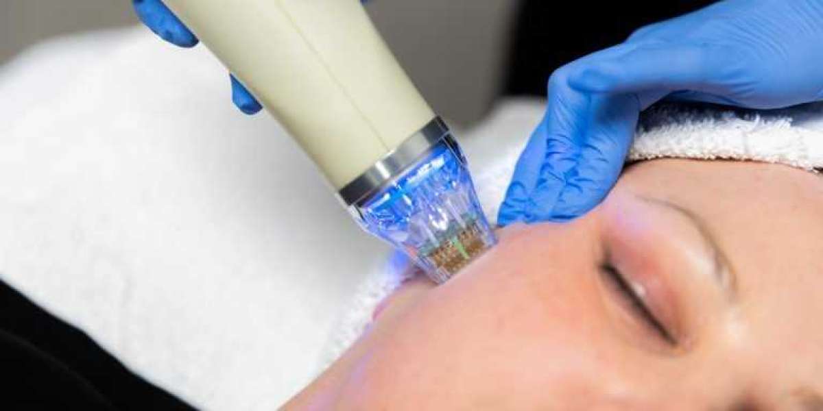 RF Microneedling in London: A Revolutionary Anti-Ageing Solution