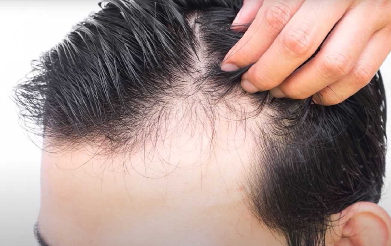 Hair transplant in Dubai