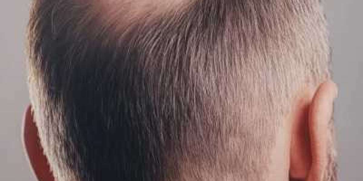 Common Side Effects and Risks of Crown Hair Transplant