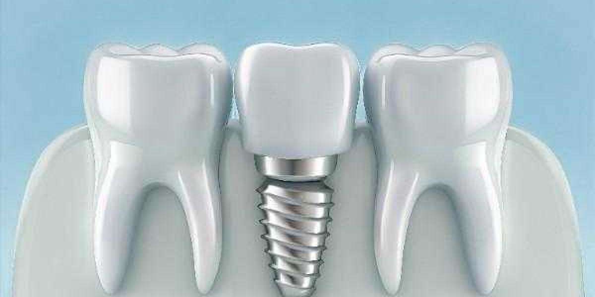 Quick Action for Tooth Loss and Implant Solutions