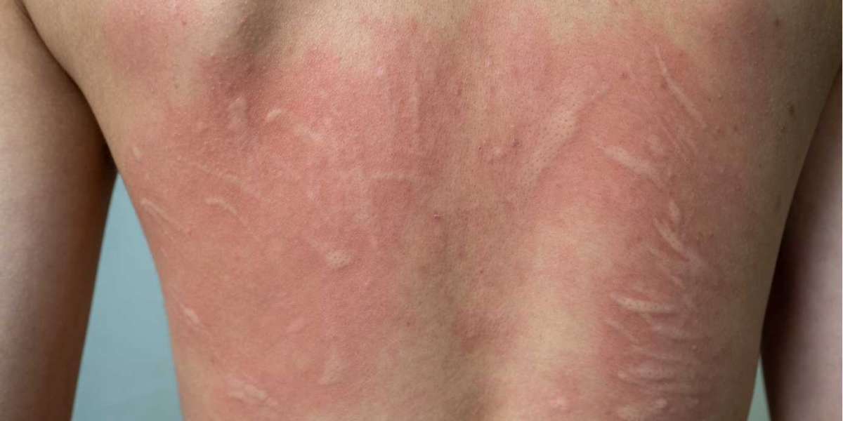 The Impact of Urticaria on Quality of Life