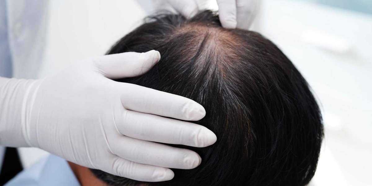 Hair Transplant Results in 12 Months in Peshawar
