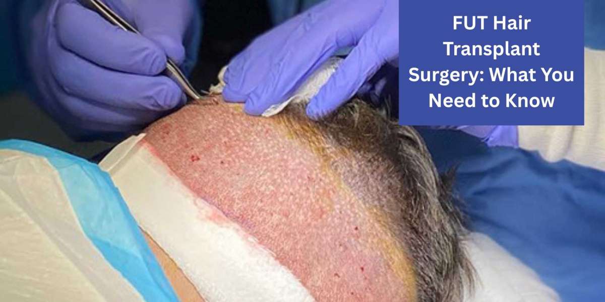 FUT Hair Transplant Surgery: What You Need to Know