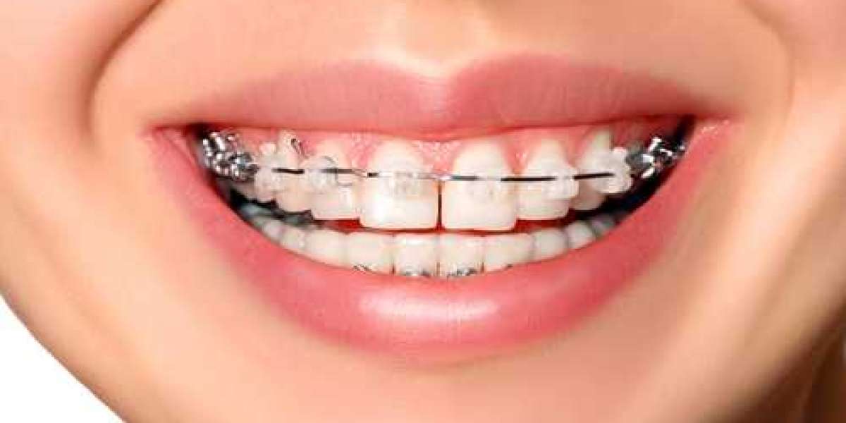 Can You Get Braces Just on the Top or Bottom Teeth?