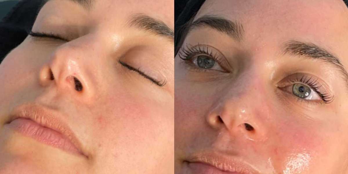Limited Offer! Discounted HydraFacial in Peshawar