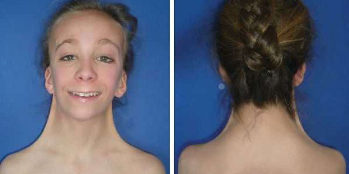 Turner Syndrome Market to Grow at Highest Pace Owing to Hormone Therapies