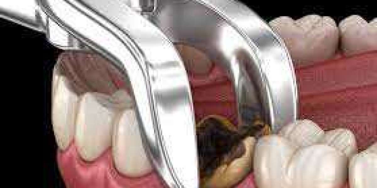 Can Tooth Removal Affect Your Jawbone?