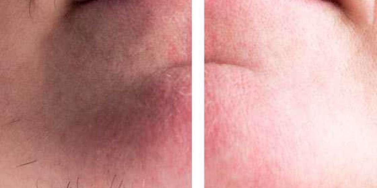 Permanent Hair Reduction Made Easy in Peshawar