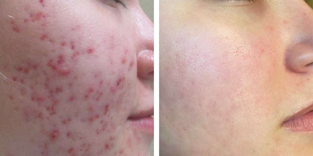 Gentle Yet Powerful: Microneedling for Scar-Free Skin in Peshawar