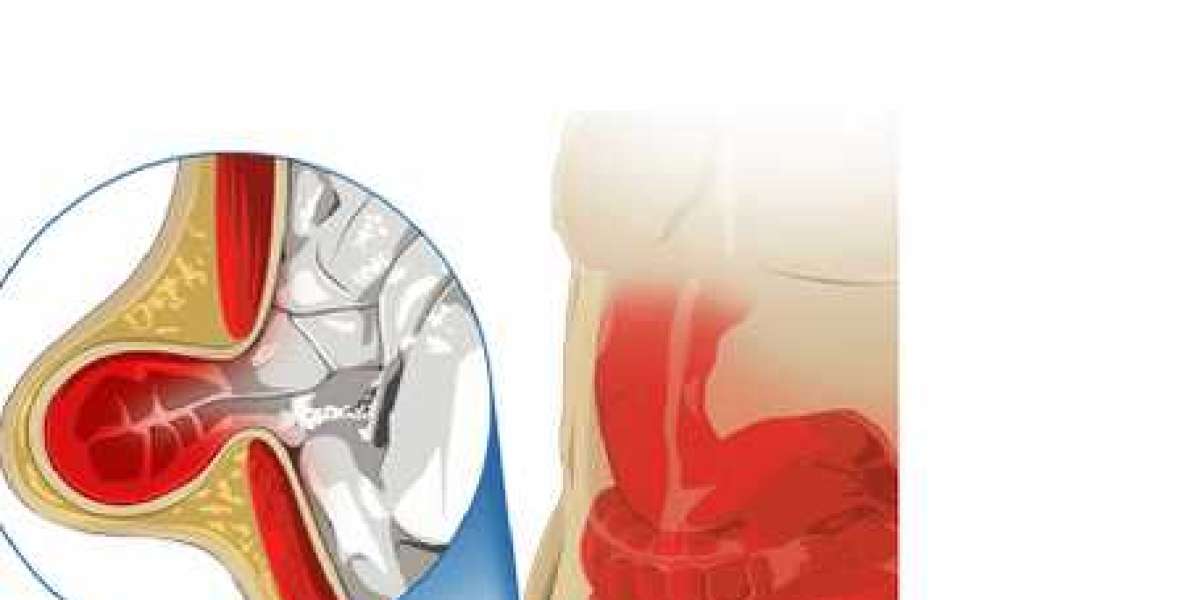 No More Belly Blues: Finding the Best Hernia Surgeon in Chennai Without Breaking the Bank