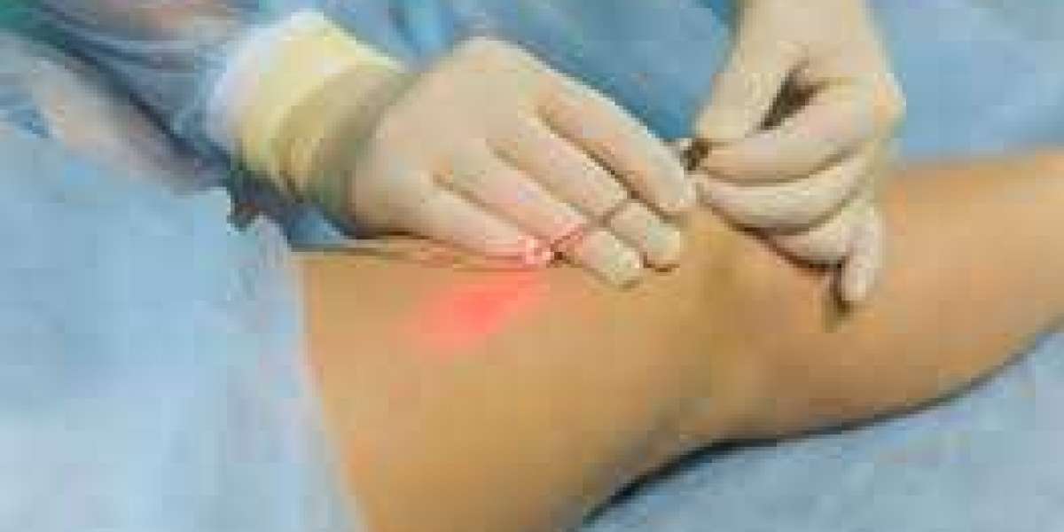 Laser Treatment for Varicose Veins: A Comprehensive Guide
