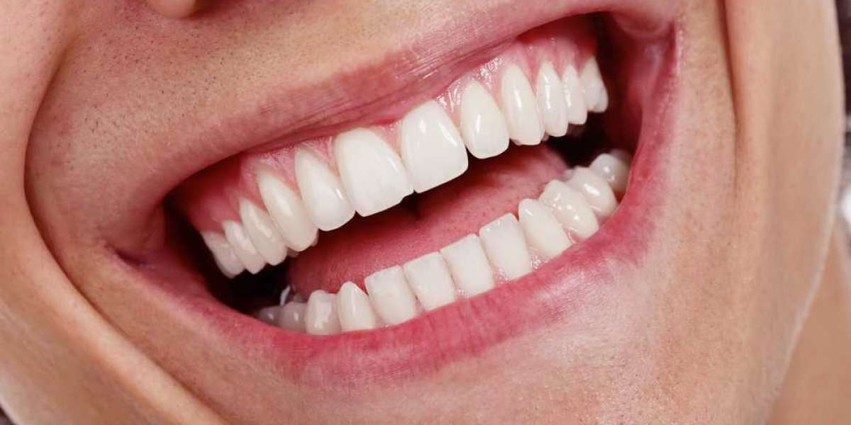 Can Teeth Whitening Work on Dental Restorations?