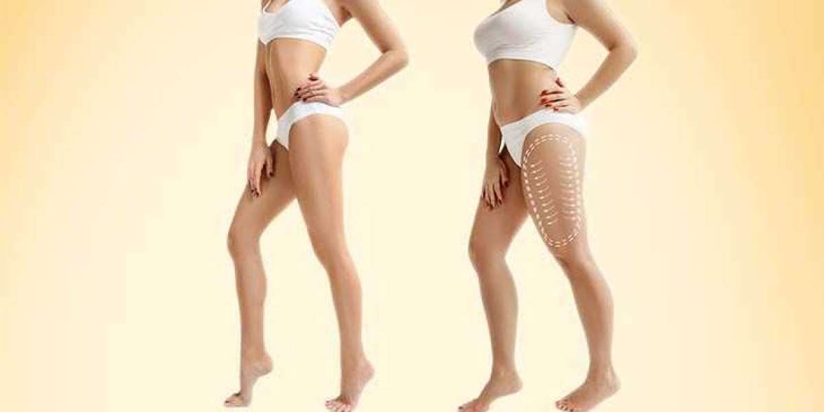 Transform Your Body with Expert Liposuction in Dubai by Dr. Hans