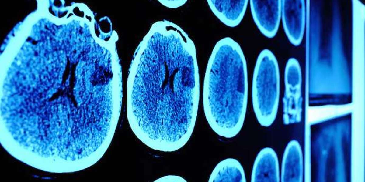 Astrocytoma Drug Market Gains on Personalized Medicine Opportunity