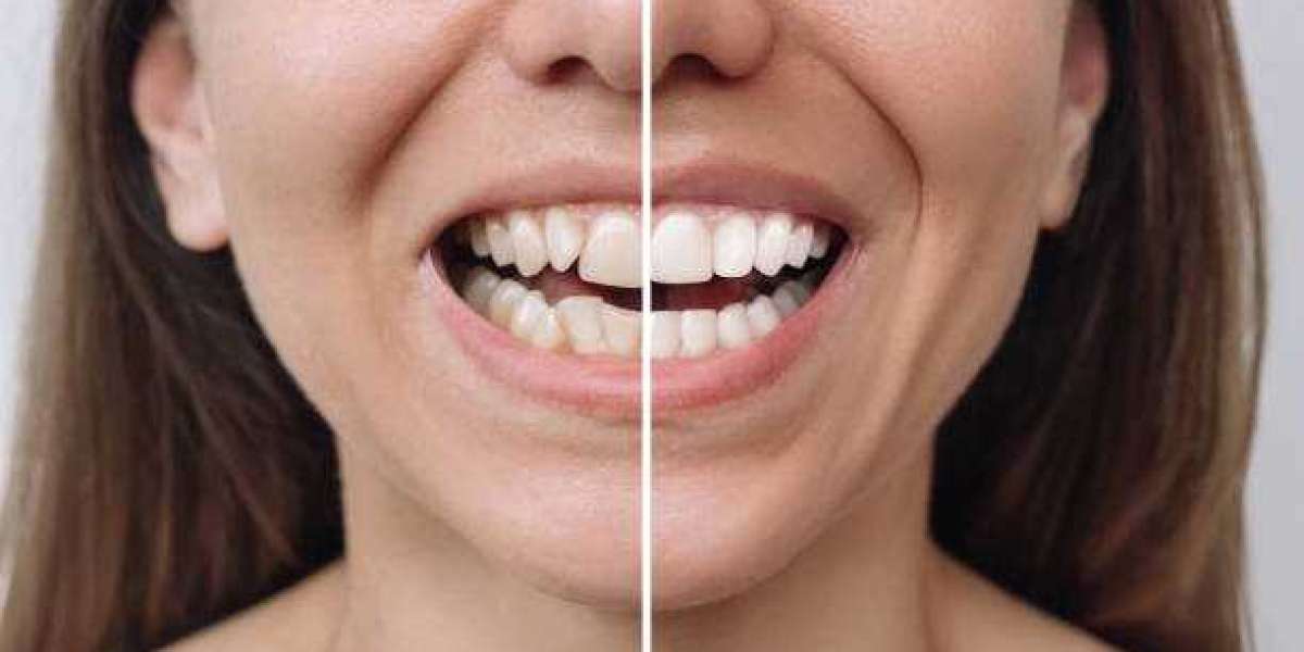 What Kind of Dentist Fixes Overlapping Teeth?