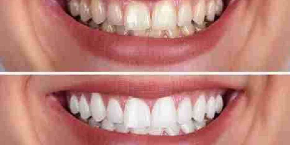 Shine Brighter with Professional Teeth Whitening Services