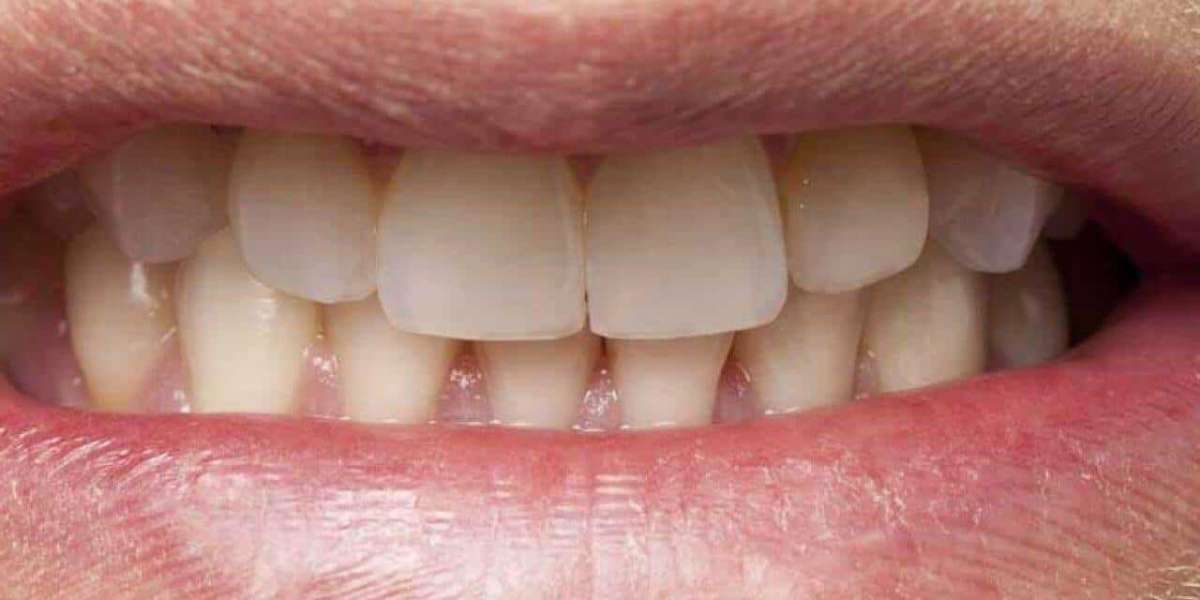 Are There Exercises to Reduce Jaw Clenching?