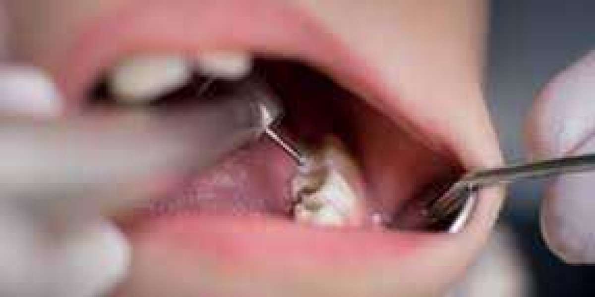 What Is the Best Filling for Front Teeth?