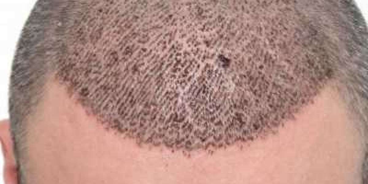 How to Avoid Infection After FUT Hair Transplant: A Complete Guide for Optimal Healing