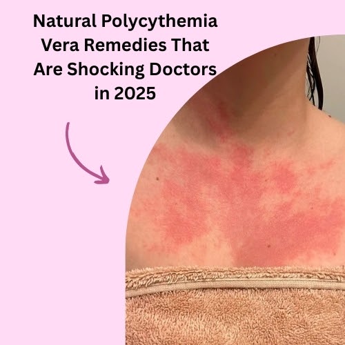 Natural Polycythemia Vera Remedies That Are Shocking Doctors in 2025
