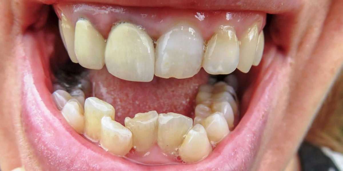 Are Overlapping Teeth Normal or a Dental Concern?