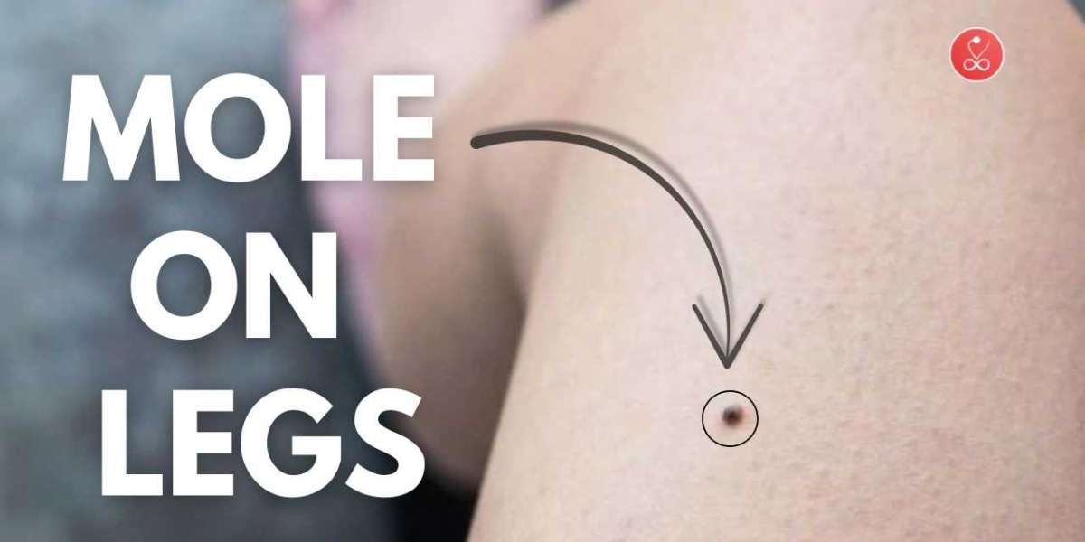 Mole on Legs - What It Really Means