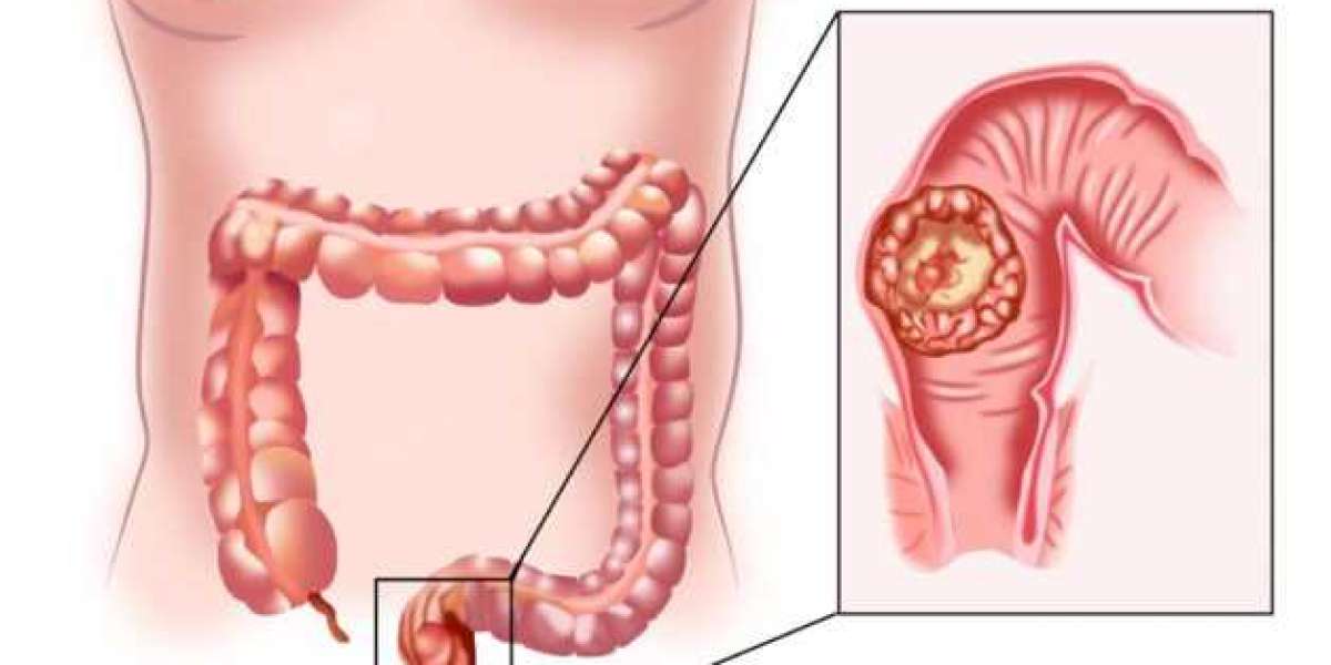 Global Anal Cancer Market Expands with Immunotherapy as Frontline Standard