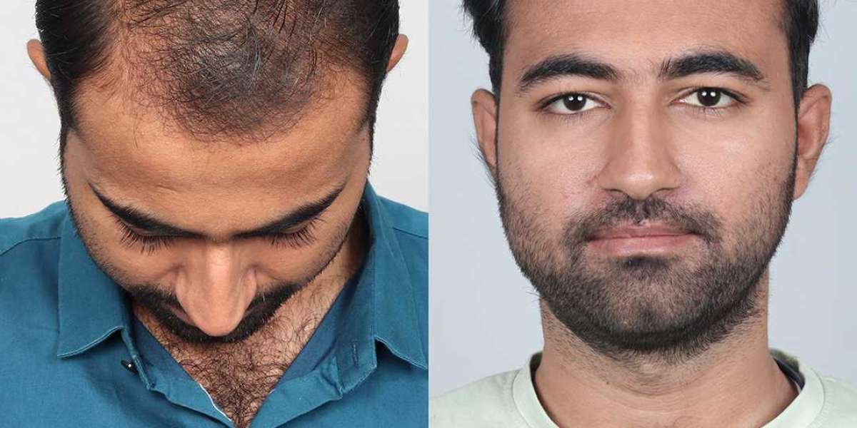 Hair Transplant Cost in India – Affordable & Advanced Solutions at QHT Clinic