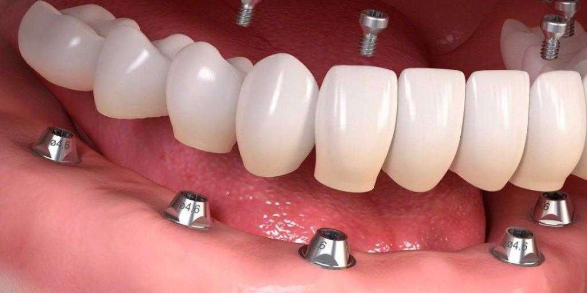 Dental Implants Albania – Affordable Excellence for Your Smile
