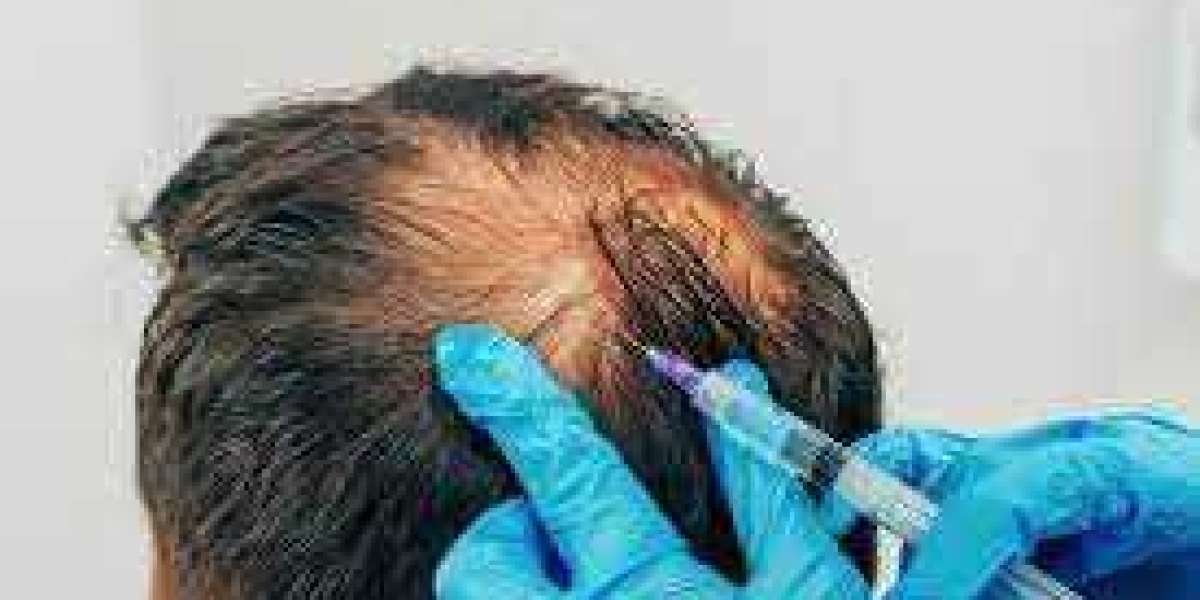 PRP for Men: Reclaim Your Hairline in the UAE