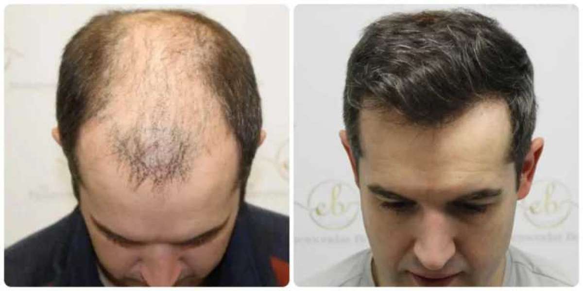 Hair Transplant: How Does It Work? Discover the Medlinks Method