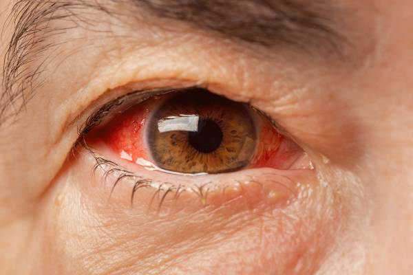 Best Glaucoma Treatment in Wakad, Punawale, Pune | Clairevision Eye Care
