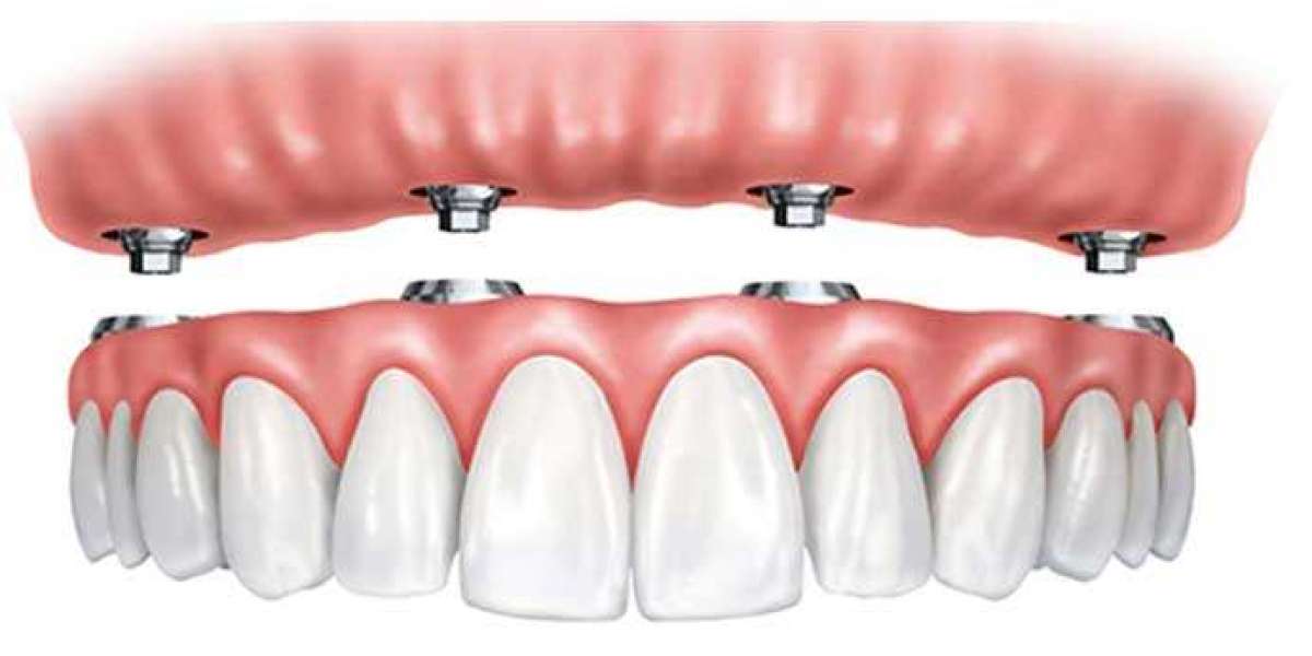 Discover the Benefits of Choosing Implantologia Dentale Albania