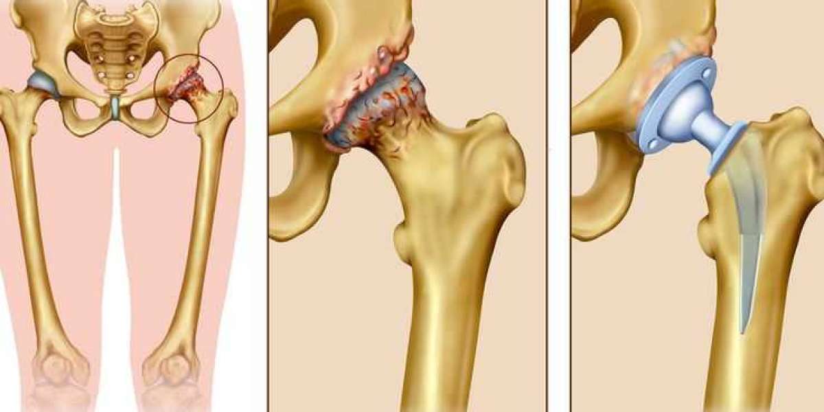 Total Hip Replacement Surgery Cost In India | Affordable Care at Dr. Khera’s Wellness Clinic