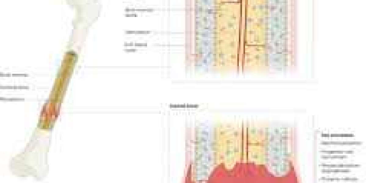 Bone Regeneration Market strategies focusing on R&D investments and novel treatment developments globally