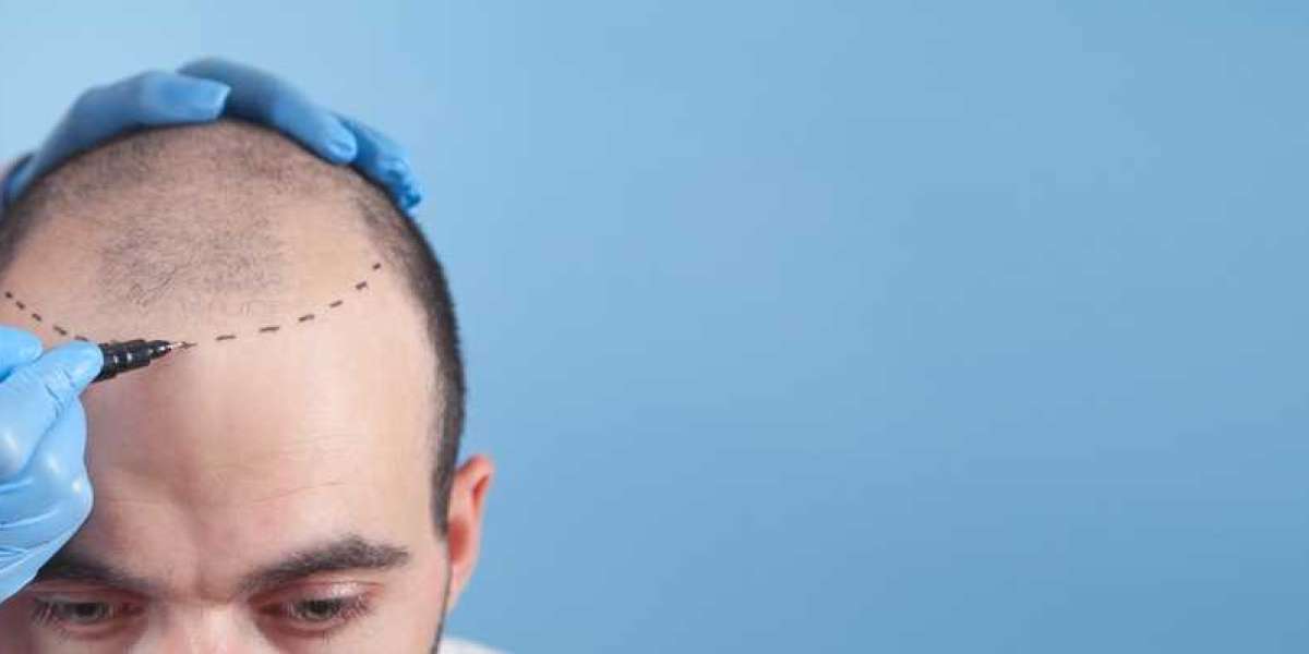 Hair Transplant Cost in Gurgaon: Is It Worth It?