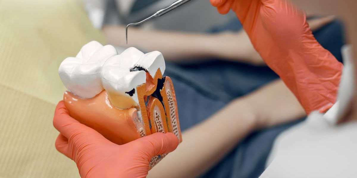 Fillings London: Expert Tooth Repair at Broadway Dental Studio