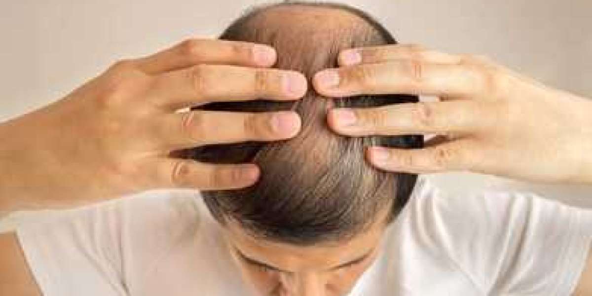 PRP vs Hair Transplant in Noida: Which Treatment Works Better?