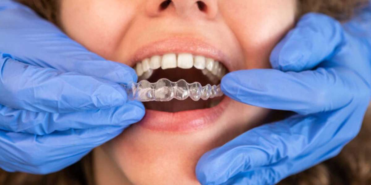 How Long Does Invisalign Treatment Usually Take?