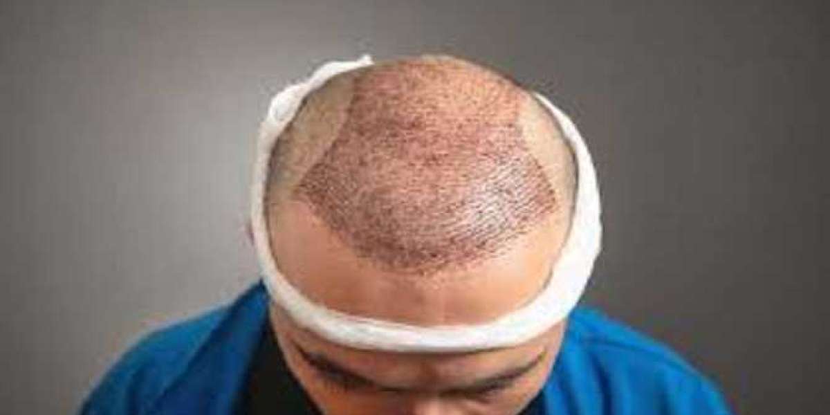 The Ultimate Guide to Hair Transplants and Restoration in Riyadh