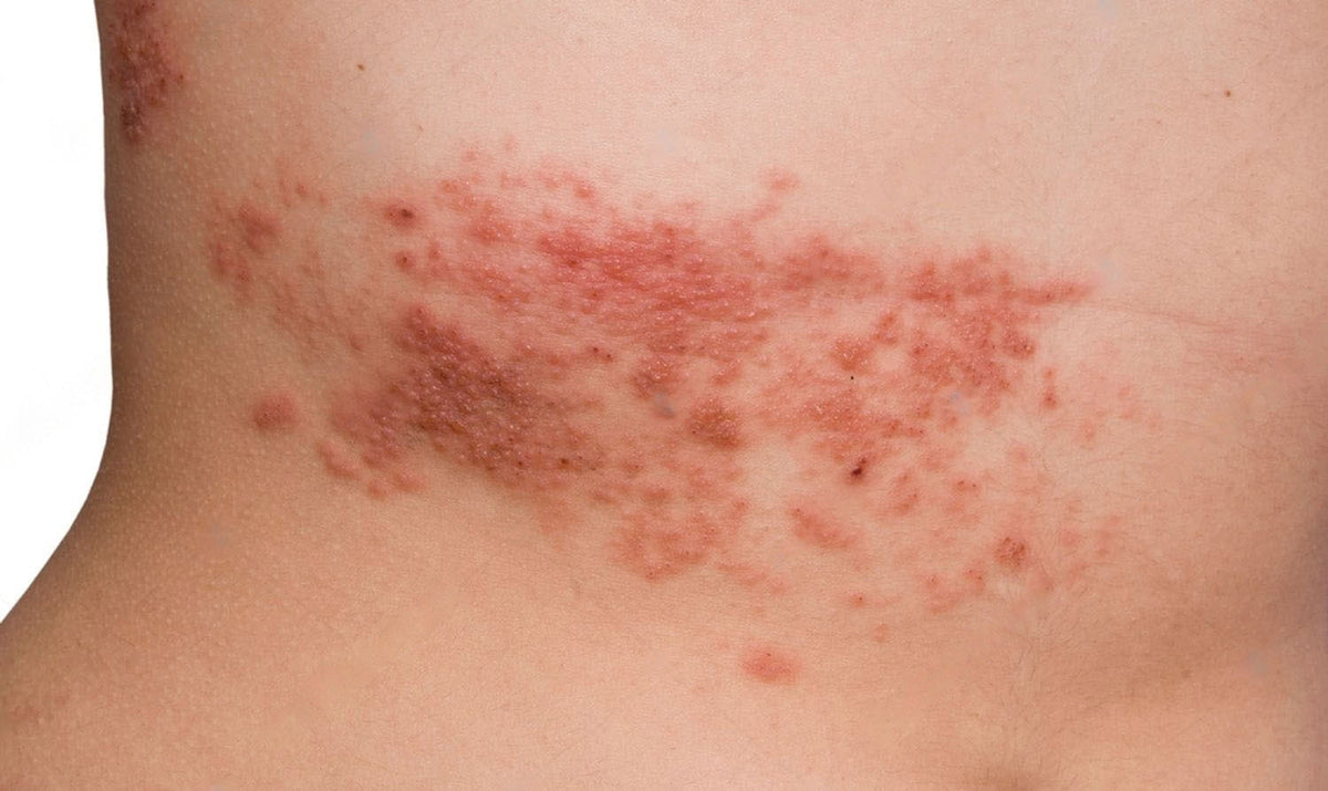 HELVETESILD BEHANDLING SOM FUNGERER– NuroKor Norge