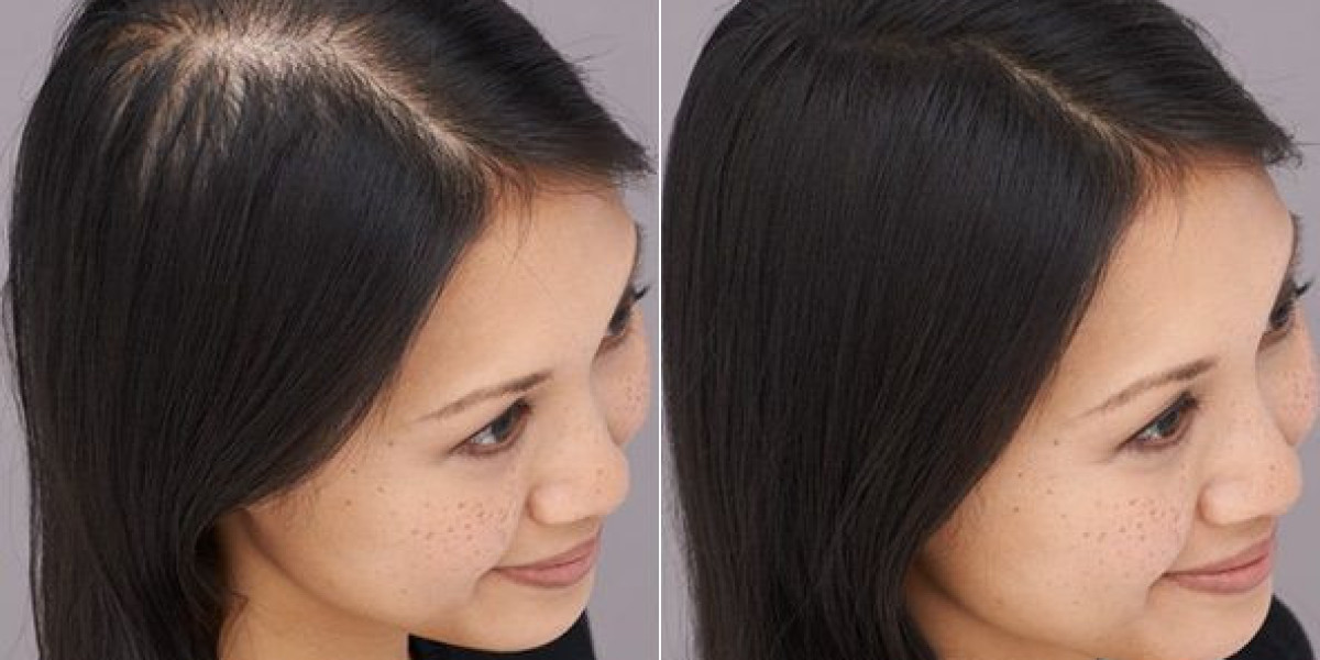 Restore Your Confidence with Hair Transplant in Dubai